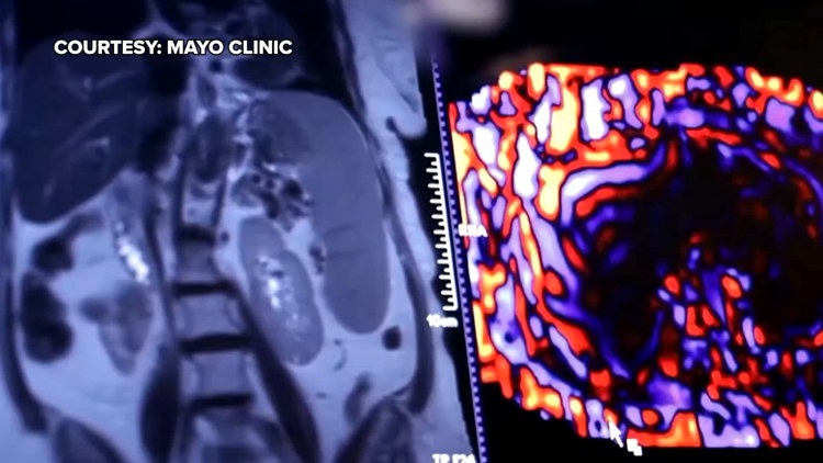 Healthy SA: Battling liver cancer, a disease which often has no symptoms early on — KENS 5 (San Antonio), Jamestown Health news